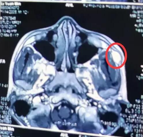 蚊子包变成“肿瘤” 台湾夫妇选择在福州眼科医院医治.jpg 蚊子包变成“肿瘤” 台湾夫妇选择在福州眼科医院医治.jpg