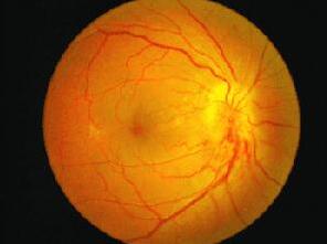 糖尿病除了引起心、脑、肾等全身多脏器损害,也引起多种眼病, 如:糖尿病性视网膜病变、白内障、新生血管性青光眼、视神经病变、葡萄膜炎、眼肌麻痹复视等。所以医生建议糖尿病患者要检查眼底。糖尿病患者应该定期去眼科检查.jpg 糖尿病除了引起心、脑、肾等全身多脏器损害,也引起多种眼病, 如:糖尿病性视网膜病变、白内障、新生血管性青光眼、视神经病变、葡萄膜炎、眼肌麻痹复视等。所以医生建议糖尿病患者要检查眼底。糖尿病患者应该定期去眼科检查.jpg