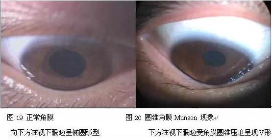 每年寒假期间,厦门眼科中心都会接诊不少学生圆锥角膜患者。大部分学生都是出现了近视、散光,戴眼镜 不佳的情况下来就诊的。厦门眼科中心眼表及角膜病专科吴护平主任提醒:青少年视力下降明显要警惕圆锥角膜1.jpg 每年寒假期间,厦门眼科中心都会接诊不少学生圆锥角膜患者。大部分学生都是出现了近视、散光,戴眼镜 不佳的情况下来就诊的。厦门眼科中心眼表及角膜病专科吴护平主任提醒:青少年视力下降明显要警惕圆锥角膜1.jpg