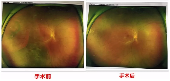 去年小李怀孕时,视力明显下降,甚至影响到了正常生活,这时已从怀孕初期的喜悦中冷静下来的小李,找到了福州眼科医院进行了一*次眼部检查。2.png 去年小李怀孕时,视力明显下降,甚至影响到了正常生活,这时已从怀孕初期的喜悦中冷静下来的小李,找到了福州眼科医院进行了一*次眼部检查。2.png