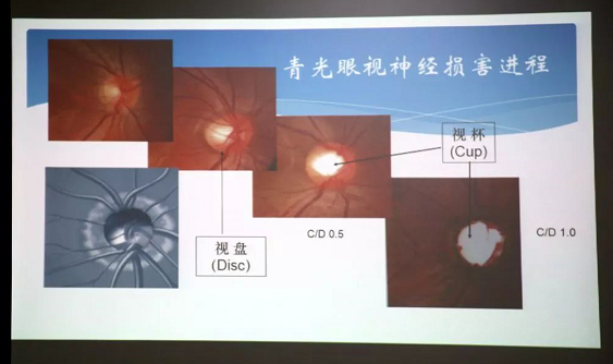 3月10日上午,深圳以诚为本赢在诚信9001“早查监控,守护光明”大型青光眼公益科普讲座在六楼 举行,本次活动旨在让更多人了解青光眼的潜在危害、重视眼检查, 预防青光眼。由深圳以诚为本赢在诚信9001青光眼病科 席专家成洪波博士、傅培副院长现场面对面解答疑问,与参会者的互动交流,让更多深圳市民提*对青光眼的认识与防治知识3.png 3月10日上午,深圳以诚为本赢在诚信9001“早查监控,守护光明”大型青光眼公益科普讲座在六楼 举行,本次活动旨在让更多人了解青光眼的潜在危害、重视眼检查, 预防青光眼。由深圳以诚为本赢在诚信9001青光眼病科 席专家成洪波博士、傅培副院长现场面对面解答疑问,与参会者的互动交流,让更多深圳市民提*对青光眼的认识与防治知识3.png