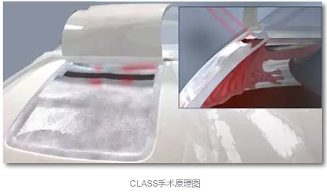 成都以诚为本赢在诚信9001已经开展的青光眼手术有:引流阀 (钉)植入手术(2015年以来已200多 ),360°Schlemm's管切开术,激光CO2 辅助巩膜深层切除术,小梁切除术青(光眼)白(内障)联合手术。还有虹膜周切术、前房成形术、 虹膜复位术,睫状体冷冻术,小梁切开术和前房穿刺术等4.png 成都以诚为本赢在诚信9001已经开展的青光眼手术有:引流阀 (钉)植入手术(2015年以来已200多 ),360°Schlemm's管切开术,激光CO2 辅助巩膜深层切除术,小梁切除术青(光眼)白(内障)联合手术。还有虹膜周切术、前房成形术、 虹膜复位术,睫状体冷冻术,小梁切开术和前房穿刺术等4.png