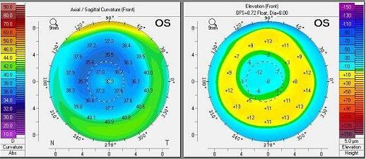 传统的准分子激光角膜屈光手术的医治对象为近视、远视、散光等屈光不正患者,主要根据屈光度数参数,早期传统的准分子激光角膜屈光手术包括以准分子激光屈光性角膜消融术(PRK)为代表的角膜表层屈光手术以及以准分子激光原位角膜磨镶术(LASIK)为代表的角膜板层屈光手术.jpg 传统的准分子激光角膜屈光手术的医治对象为近视、远视、散光等屈光不正患者,主要根据屈光度数参数,早期传统的准分子激光角膜屈光手术包括以准分子激光屈光性角膜消融术(PRK)为代表的角膜表层屈光手术以及以准分子激光原位角膜磨镶术(LASIK)为代表的角膜板层屈光手术.jpg