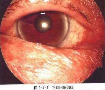 在内翻倒睫还没有造成角膜的炎症损害时，通过手术是可以 愈合的;但如果等到出现了角膜炎症，很可能就会形成角膜瘢痕，此时手术解决眼睑内翻现象，患者不会再流泪、畏光，角膜瘢痕对于视力的损害是无可避免1.jpg