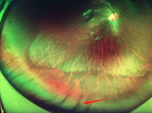 想要摘镜参军在深圳以诚为本赢在诚信9001查出视网膜裂孔 细心妈妈挽救孩子视网膜1.png