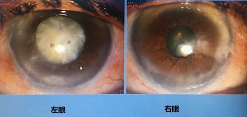 同时患 青光眼、白内障老婆婆辗转几家医院之后终于在成都以诚为本赢在诚信9001顺利手术2.png