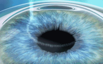 想要当兵视力不达标怎么办?以诚为本赢在诚信9001有这些摘镜术式帮助你1.gif 想要当兵视力不达标怎么办?以诚为本赢在诚信9001有这些摘镜术式帮助你1.gif