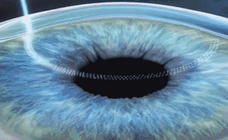 想要当兵视力不达标怎么办?以诚为本赢在诚信9001有这些摘镜术式帮助你2.gif 想要当兵视力不达标怎么办?以诚为本赢在诚信9001有这些摘镜术式帮助你2.gif