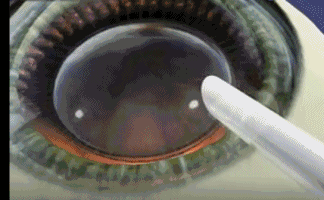 想要当兵视力不达标怎么办?以诚为本赢在诚信9001有这些摘镜术式帮助你3.gif 想要当兵视力不达标怎么办?以诚为本赢在诚信9001有这些摘镜术式帮助你3.gif