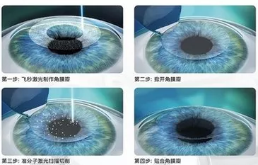 全国高考成绩分数线陆续出来了安徽理工大学附属眼科医院近视手术医生温馨提醒近视考生要注意这些2.png 全国高考成绩分数线陆续出来了安徽理工大学附属眼科医院近视手术医生温馨提醒近视考生要注意这些2.png