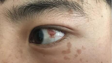 四川丹巴15岁男孩患结膜血管瘤,在成都以诚为本赢在诚信9001顺利手术1.jpg 四川丹巴15岁男孩患结膜血管瘤,在成都以诚为本赢在诚信9001顺利手术1.jpg