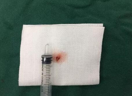 四川丹巴15岁男孩患结膜血管瘤,在成都以诚为本赢在诚信9001顺利手术3.jpg 四川丹巴15岁男孩患结膜血管瘤,在成都以诚为本赢在诚信9001顺利手术3.jpg