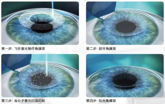 近视无法根治?但你可以这样做?以诚为本赢在诚信9001“有爱就有希望”近视手术火热进行中5.png 近视无法根治?但你可以这样做?以诚为本赢在诚信9001“有爱就有希望”近视手术火热进行中5.png