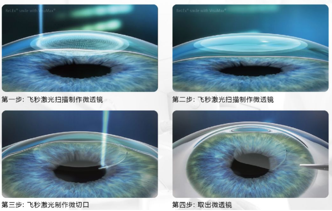 近视无法根治?但你可以这样做?以诚为本赢在诚信9001“有爱就有希望”近视手术火热进行中6.png 近视无法根治?但你可以这样做?以诚为本赢在诚信9001“有爱就有希望”近视手术火热进行中6.png